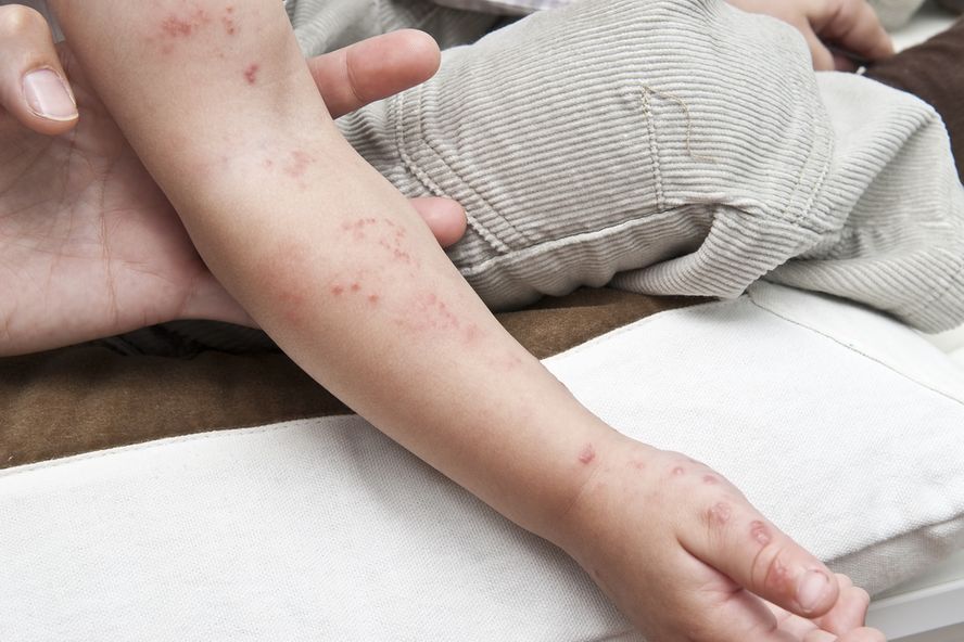 Is It Chicken Pox, Or Could It Be Foot And Mouth Disease?