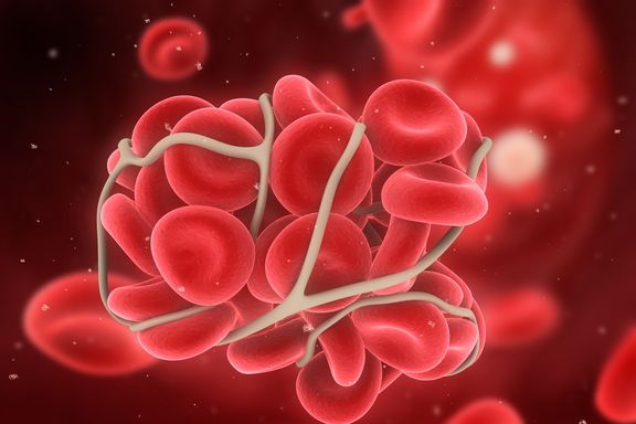 Common Signs and Symptoms of a Blood Clot