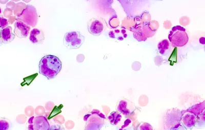 Lupus