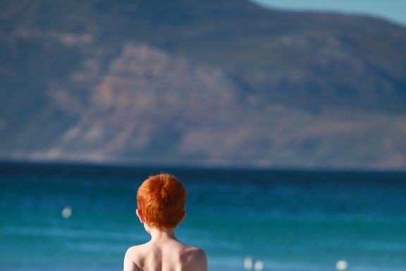 Red Heads May be Genetically Predisposed to Melanoma