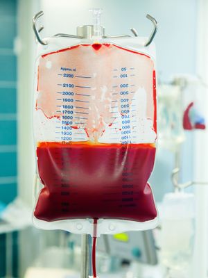anemia iron deficient