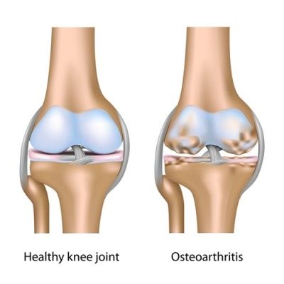 OAK (Osteoarthritis of the Knee)