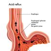 Heartburn Trigger Foods: Control Acid Reflux - ActiveBeat