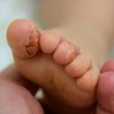 Probiotics Reduce Problem Skin for Infants
