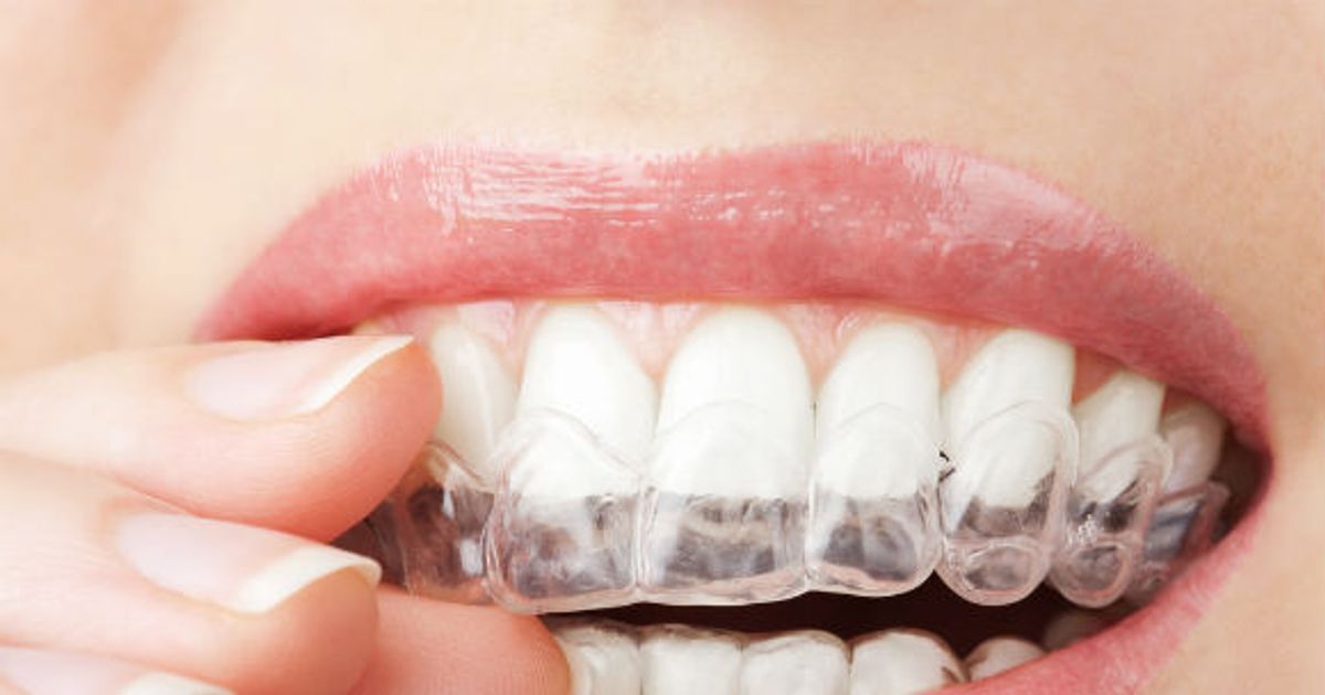 The Unknown Dangers of Teeth Whitening ActiveBeat