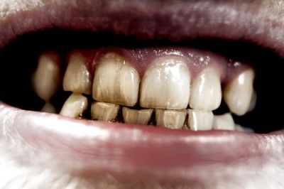 bad teeth