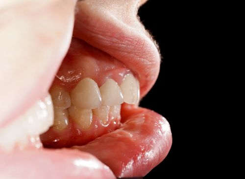 Gums