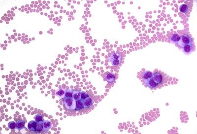Leukemia