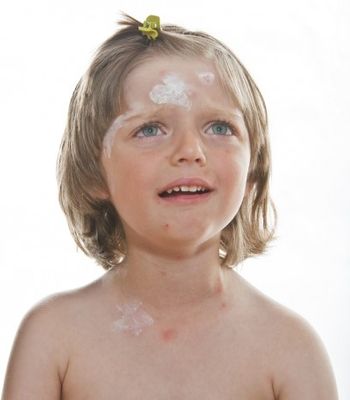 chicken pox cry