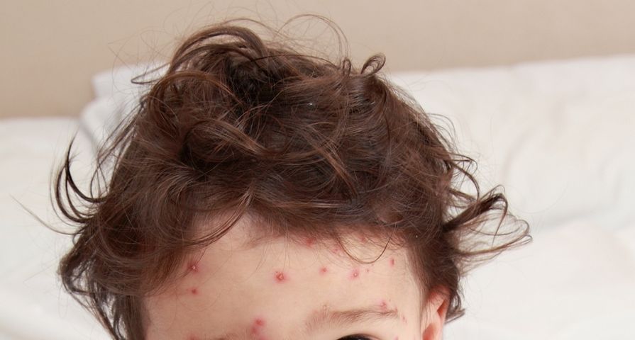 Chicken Pox Symptoms: 8 Signs of Chicken Pox - ActiveBeat