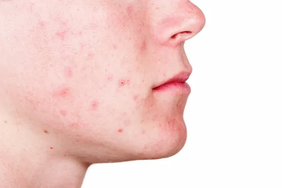 13 Aliments capables de déclencher votre acné