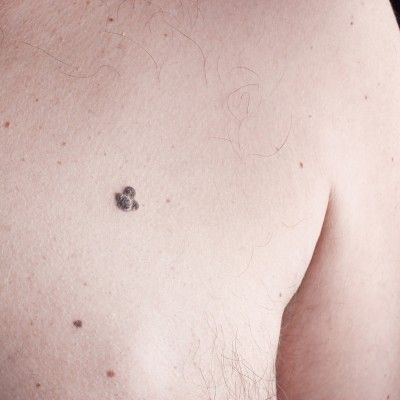 asymetric mole