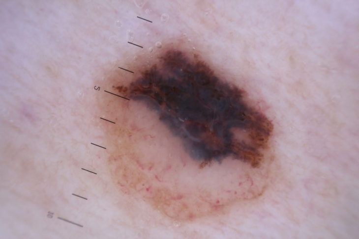 Signs of Abnormal Moles and When They Should Be Removed - ActiveBeat
