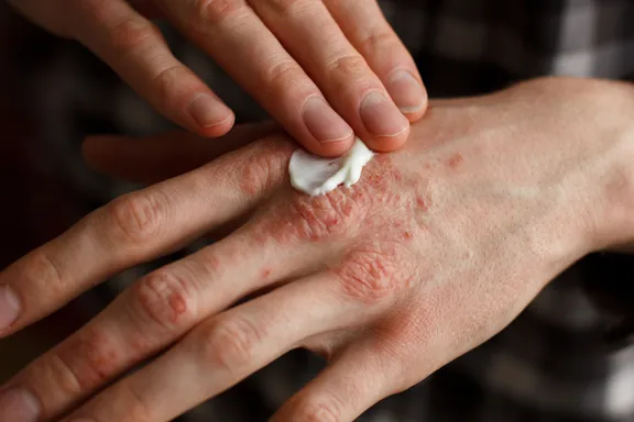 Must-Have Lotions for Treating Psoriasis