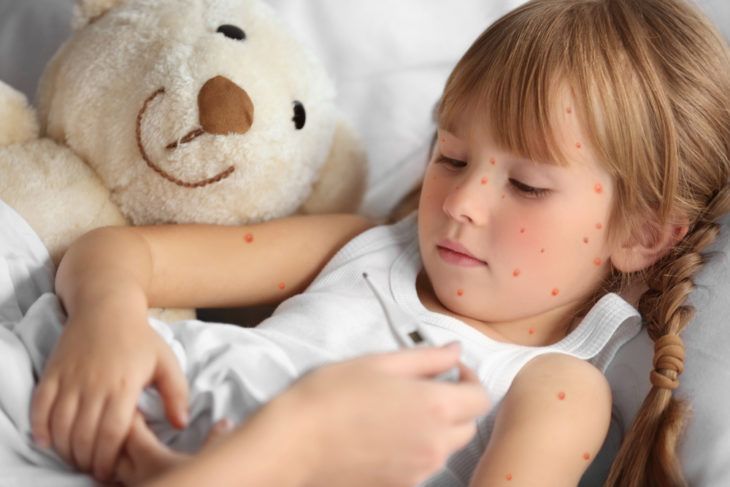 Chicken Pox: Common Signs of Chickenpox - ActiveBeat