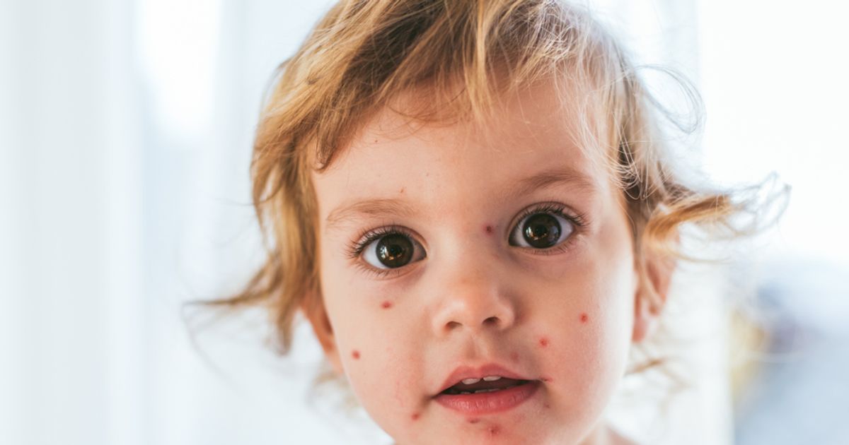 Chicken Pox Common Signs of Chickenpox ActiveBeat