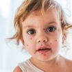Chicken Pox: Common Signs of Chickenpox