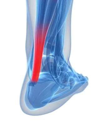 Achilles Tendinitis