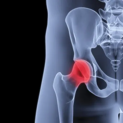 Strained Groin