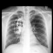 Doce enfermedades que dificultan la respiración