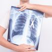 Lung Cancer: Early Signs and Symptoms
