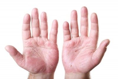 swollen hands