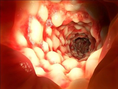 colitis 1