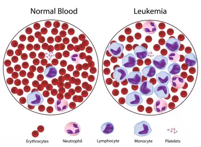 leukemia 3