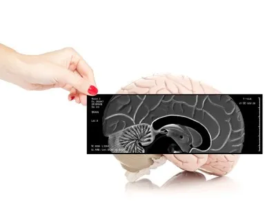 brain tumor 3