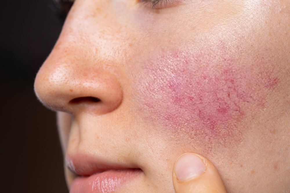 Common Symptoms of Rosacea - ActiveBeat