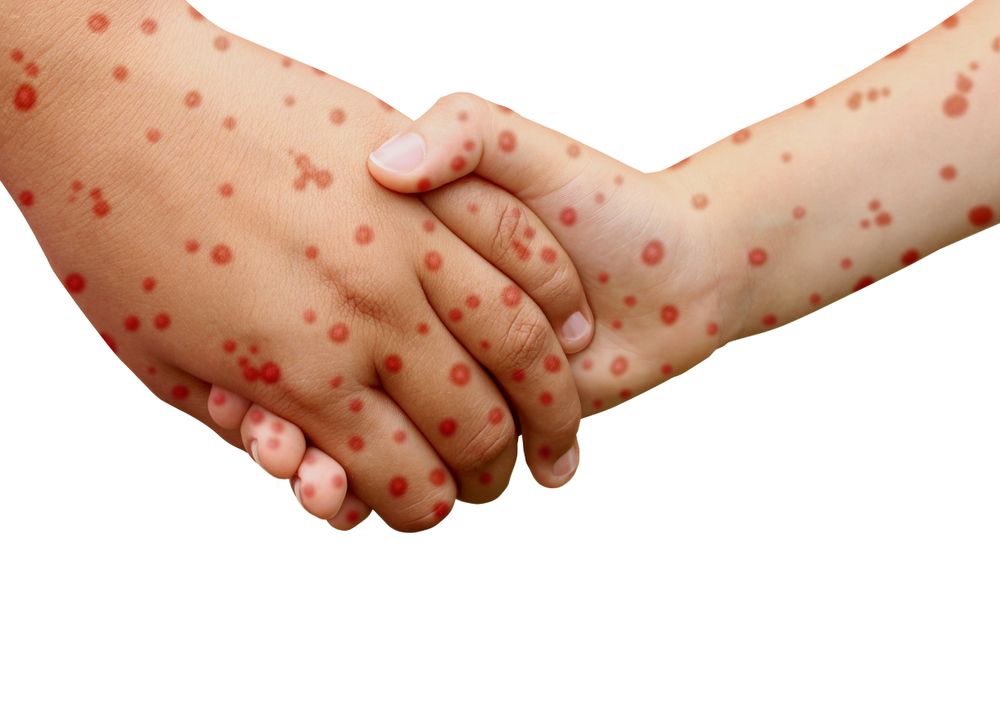 Is It Measles? Signs and Symptoms of Measles - ActiveBeat