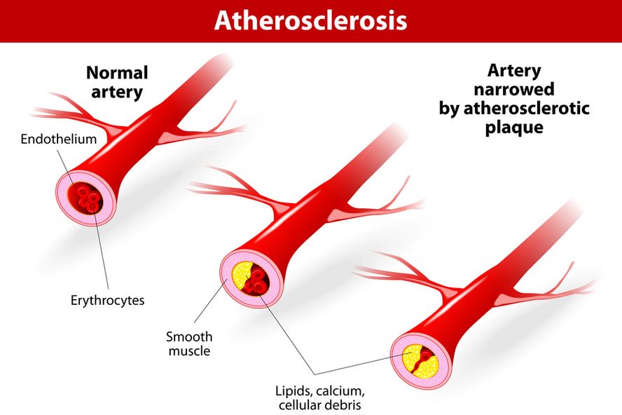 Peut On Vivre Longtemps Avec Un Anévrisme De L Aorte