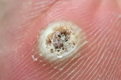 wart 3