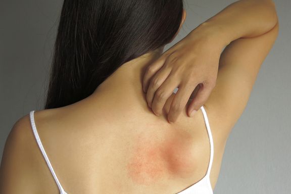 Possible Causes of Irritating Skin Rashes