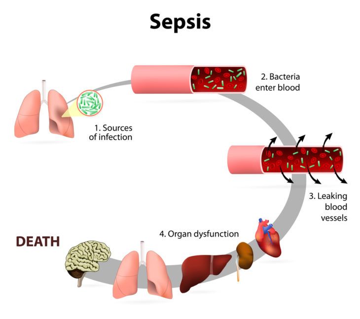 The Signs, Symptoms, and Causes of Sepsis ActiveBeat