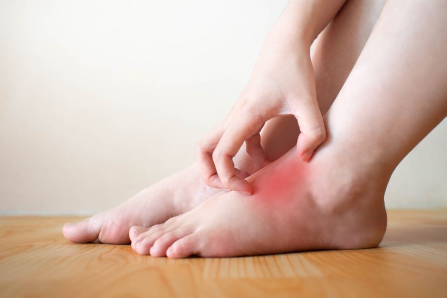 Itchy, Burning Symptoms of Athlete’s Foot