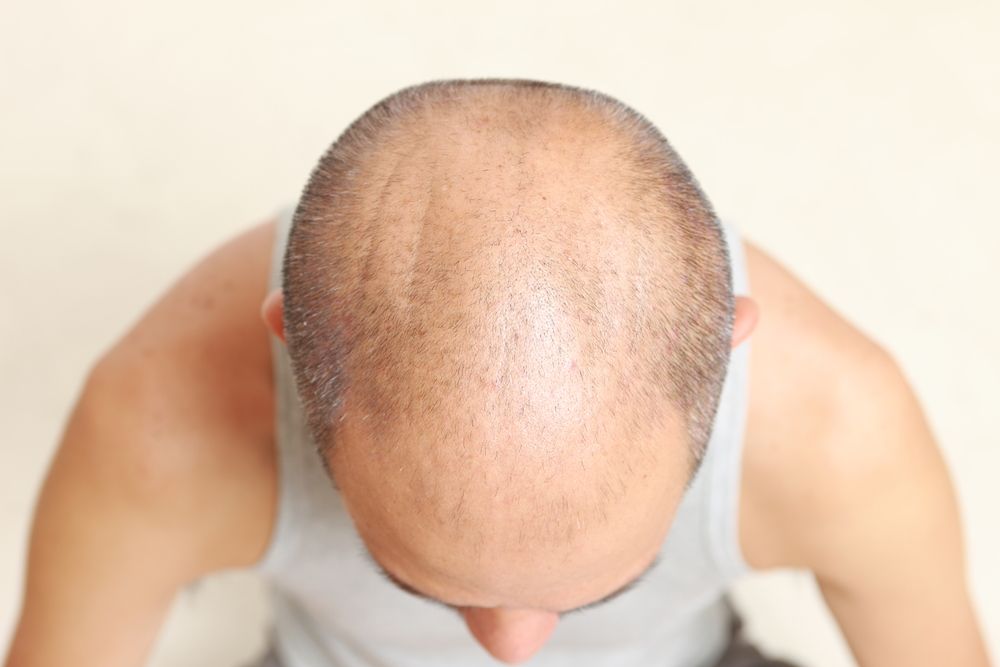 Plucking Hairs Could Stimulate Hair Growth Activebeat