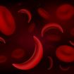 El ABC de la anemia drepanocítica