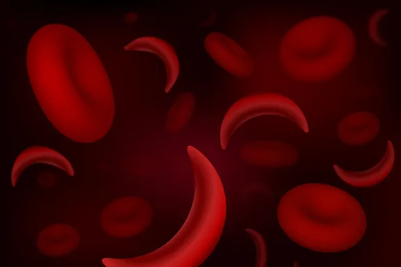 What to Know About Sickle Cell Anemia