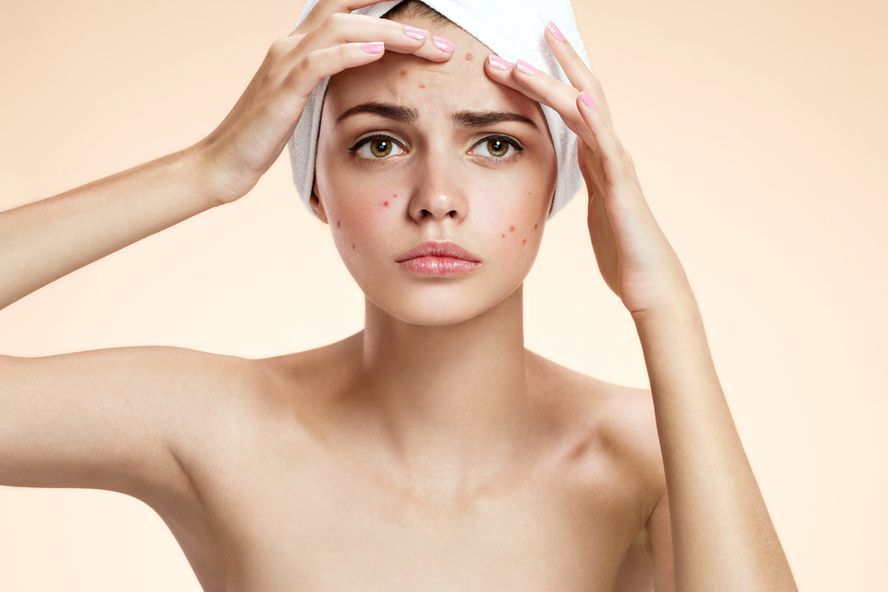 Diez tratamientos tópicos para el acné