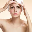 Diez tratamientos tópicos para el acné