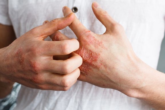 Reasons Eczema Research is Only Scratching the Surface