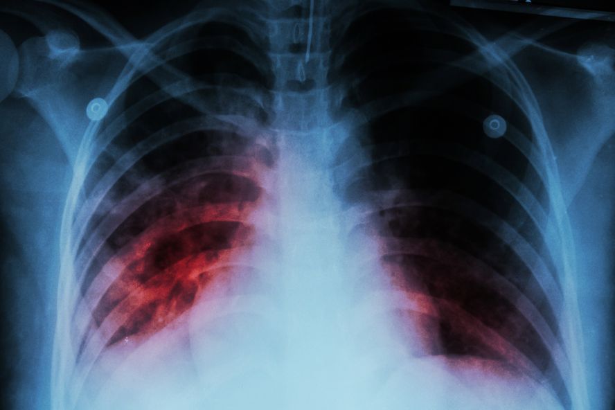 Ocho datos menos conocidos acerca de la tuberculosis