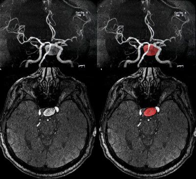 aneurysm MRI