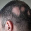 Signs and Causes of Alopecia Areata