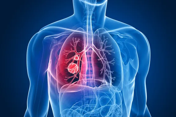 Targeted Therapies for Lung Cancer