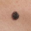 Squamous Cell Skin Cancer: Signs, Symptoms, and Treatment