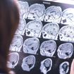 Be Mindful of These 6 Brain Atrophy Symptoms