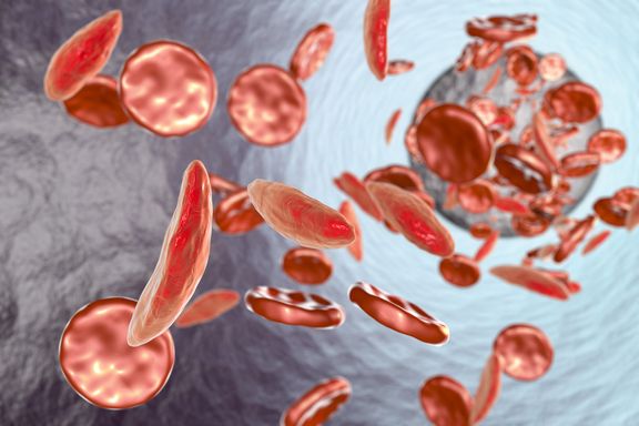 Signs and Symptoms of Sickle Cell Anemia