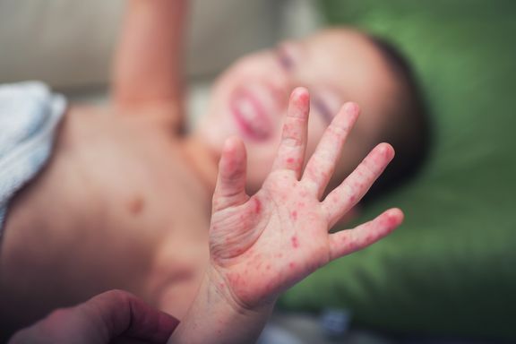 Hand, Foot and Mouth Disease: Signs, Symptoms and Treatments